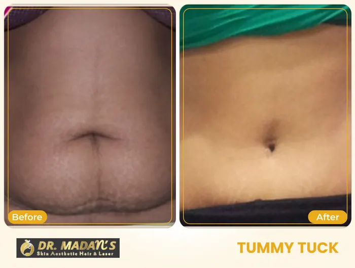 Tummy tuck before and after result 3 at Dr Madan Aesthetics